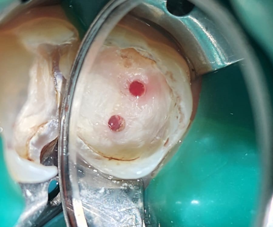 Terapia pulpar vital en diente permanente