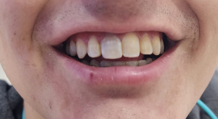 Diente anterior con cambio de color previo a evaluación para clareamiento intradentario