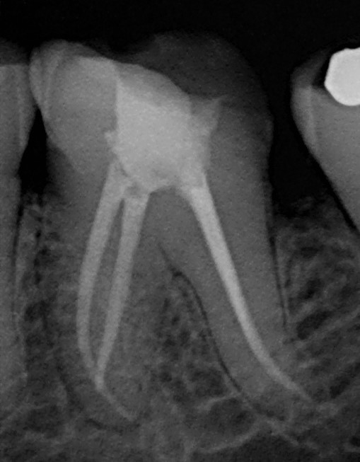Radiografía de tratamiento endodóntico
